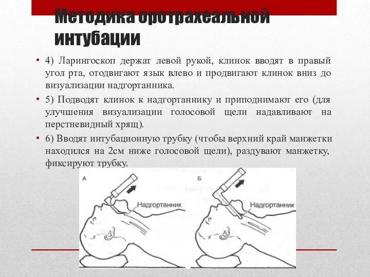 Методика оротрахеальной интубации 4) Ларингоскоп держат левой рукой, клинок вводят