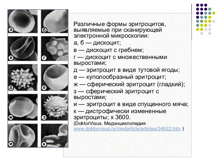 Различные формы эритроцитов, выявляемые при сканирующей электронной микроскопии: а, б — дискоцит; в
