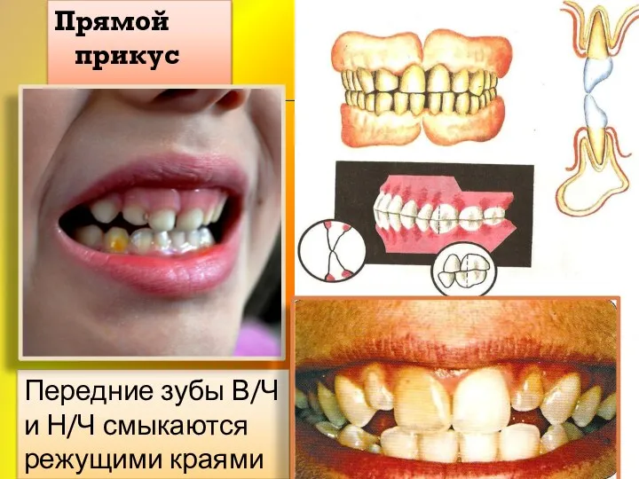 Прямой прикус Передние зубы В/Ч и Н/Ч смыкаются режущими краями