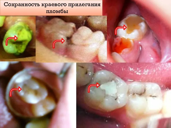 Сохранность краевого прилегания пломбы