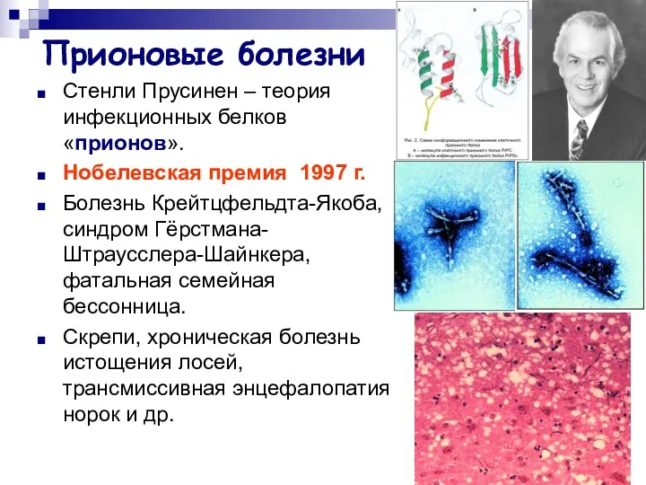 Прионовые болезни Стенли Прусинен – теория инфекционных белков «прионов». Нобелевская