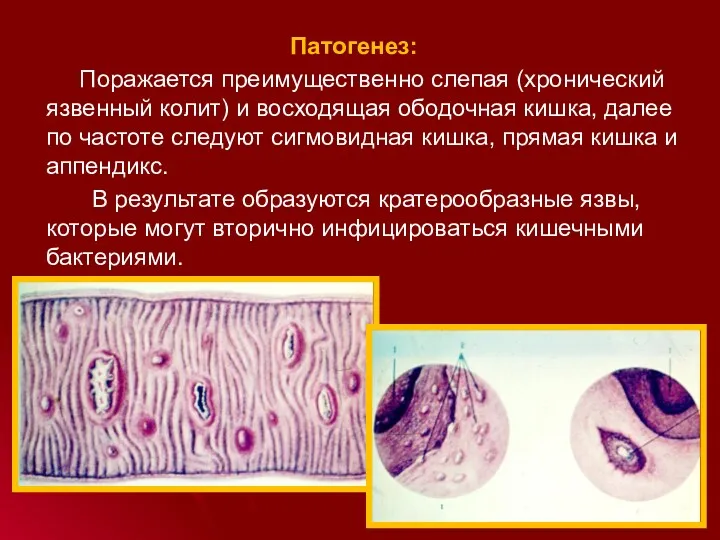 Патогенез: Поражается преимущественно слепая (хронический язвенный колит) и восходящая ободочная