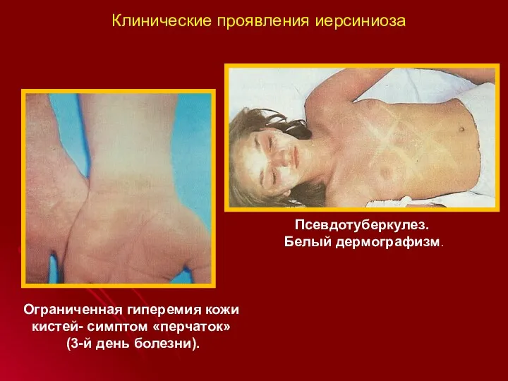 Ограниченная гиперемия кожи кистей- симптом «перчаток» (3-й день болезни). Псевдотуберкулез. Белый дермографизм. Клинические проявления иерсиниоза