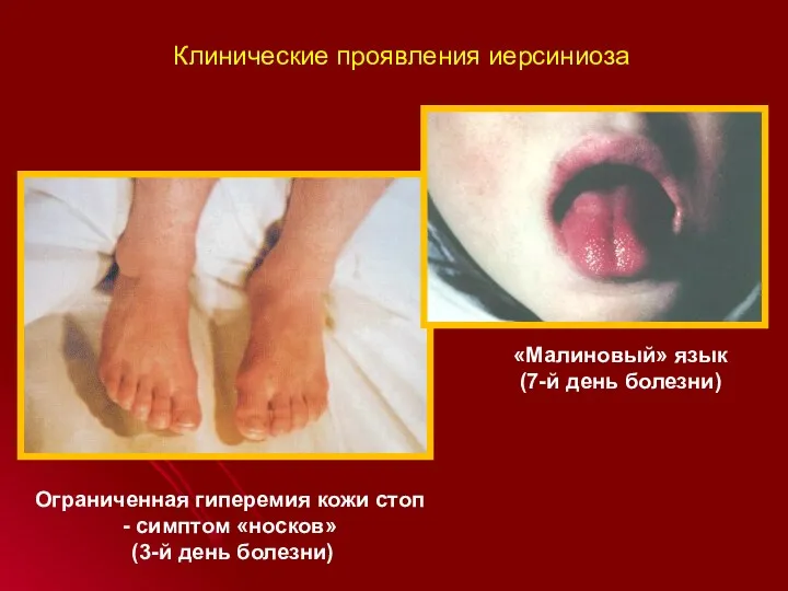 Клинические проявления иерсиниоза Ограниченная гиперемия кожи стоп - симптом «носков»