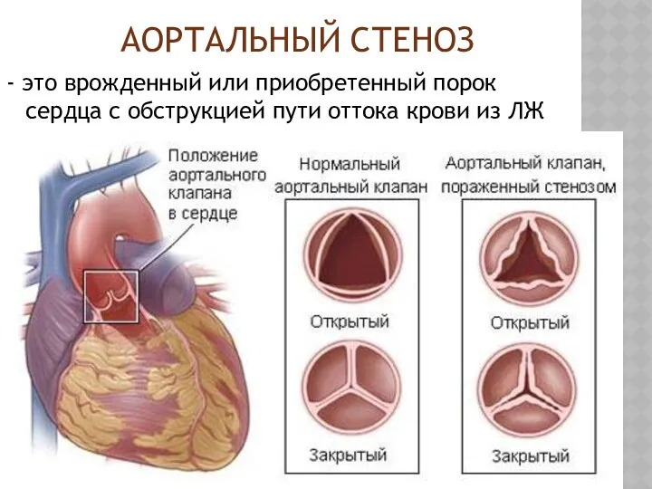 АОРТАЛЬНЫЙ СТЕНОЗ - это врожденный или приобретенный порок сердца с обструкцией пути оттока крови из ЛЖ