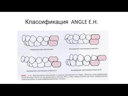 Классификация ANGLE E.H.