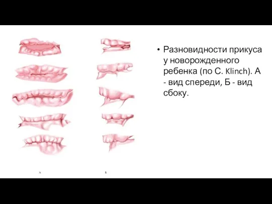 Разновидности прикуса у новорожденного ребенка (по С. Klinch). А - вид спереди, Б - вид сбоку.