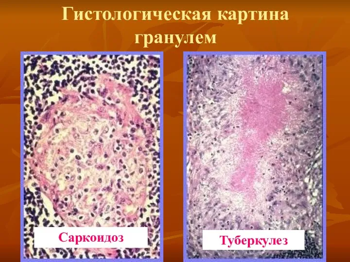 Гистологическая картина гранулем Саркоидоз Туберкулез