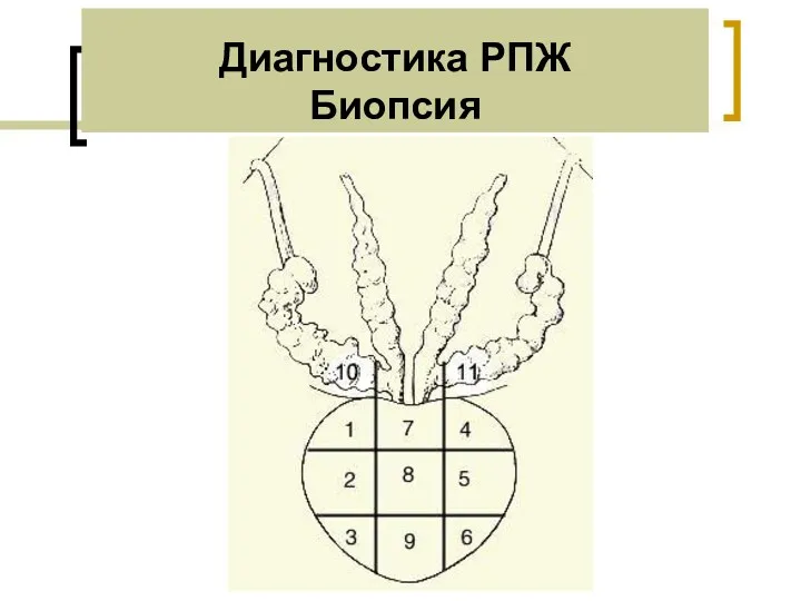 Диагностика РПЖ Биопсия