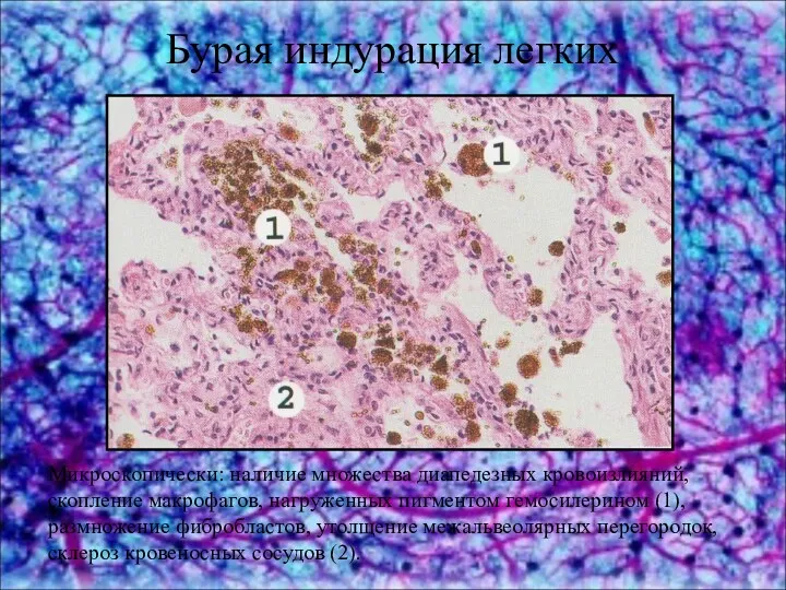 Бурая индурация легких Микроскопически: наличие множества диапедезных кровоизлияний, скопление макрофагов, нагруженных пигментом гемосилерином