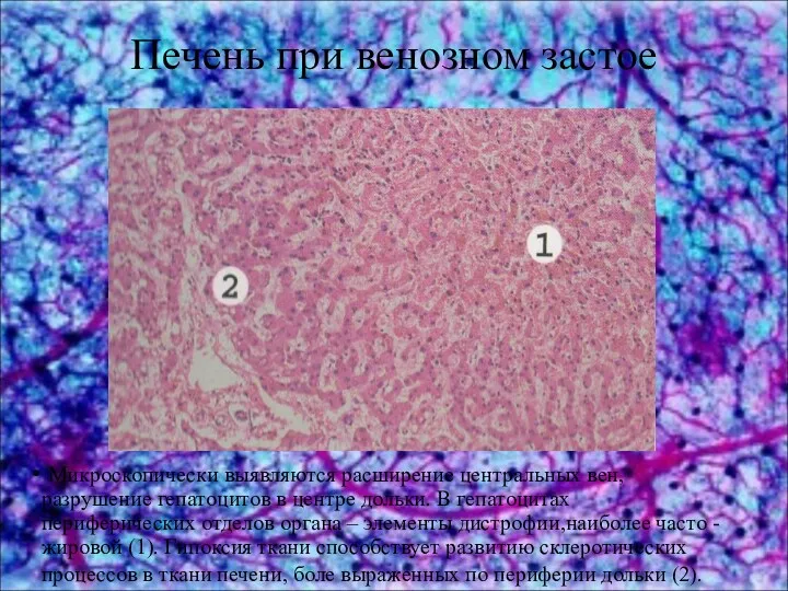 Микроскопически выявляются расширение центральных вен, разрушение гепатоцитов в центре дольки. В гепатоцитах периферических