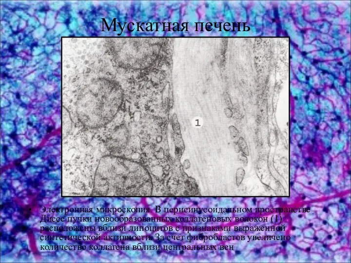 Мускатная печень Электронная микроскопия. В перисинусоидальном пространстве Диссе пучки новообразованных коллагеновых волокон (1)