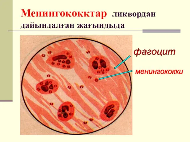 Менингококктар ликвордан дайындалған жағындыда фагоцит менингококки