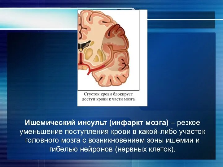 Ишемический инсульт (инфаркт мозга) – резкое уменьшение поступления крови в