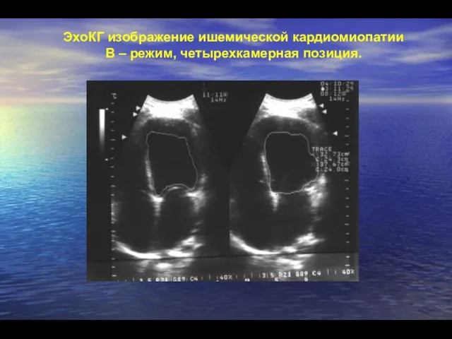 ЭхоКГ изображение ишемической кардиомиопатии В – режим, четырехкамерная позиция.
