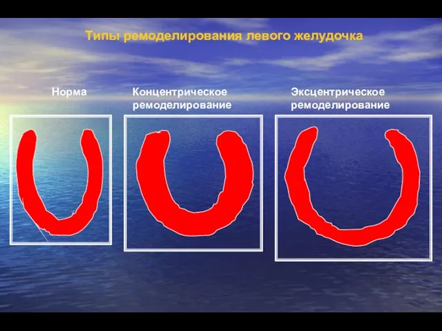 Типы ремоделирования левого желудочка Норма Концентрическое ремоделирование Эксцентрическое ремоделирование