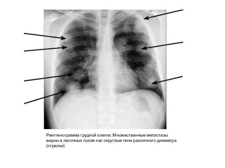 Рентгенограмма грудной клетки. Множественные метастазы видны в легочных полях как округлые тени различного диаметра (стрелки)
