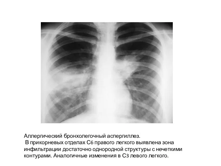 Аллергический бронхолегочный аспергиллез. В прикорневых отделах С6 правого легкого выявлена