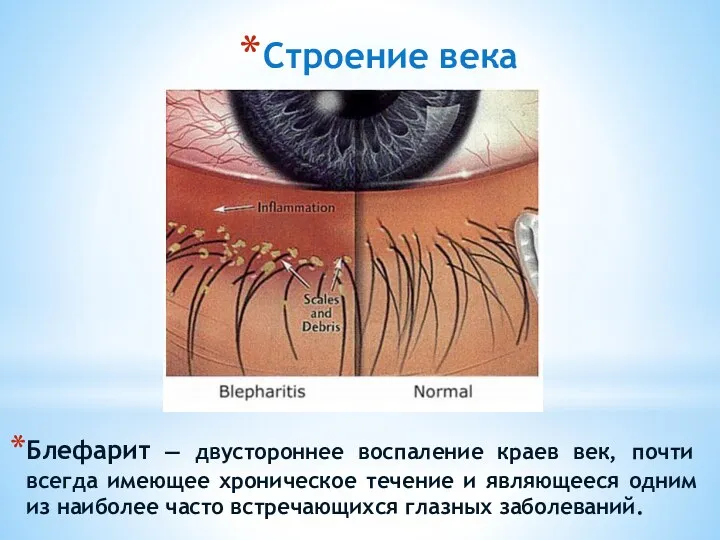 Строение века Блефарит — двустороннее воспаление краев век, почти всегда