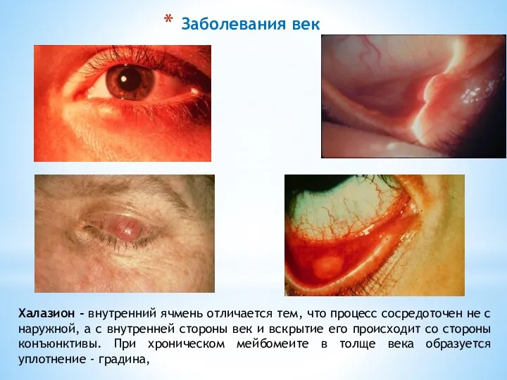 Заболевания век Халазион - внутренний ячмень отличается тем, что процесс