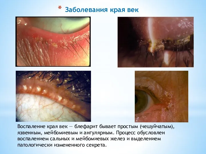 Заболевания края век Воспаление края век — блефарит бывает простым