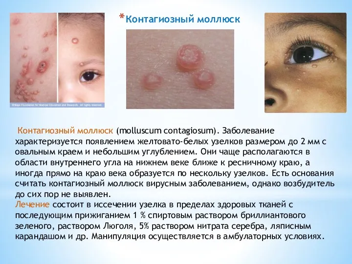 Контагиозный моллюск (molluscum contagiosum). Заболевание характеризуется появлением желтовато-белых узелков размером