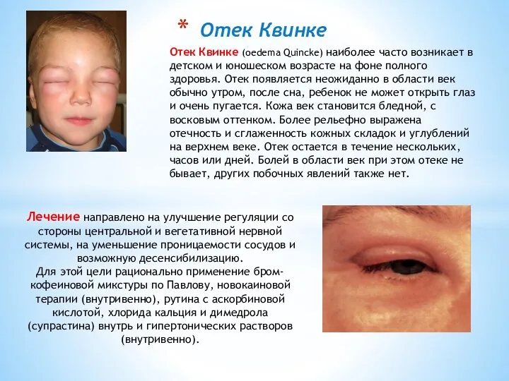 Отек Квинке Отек Квинке (oedema Quincke) наиболее часто возникает в