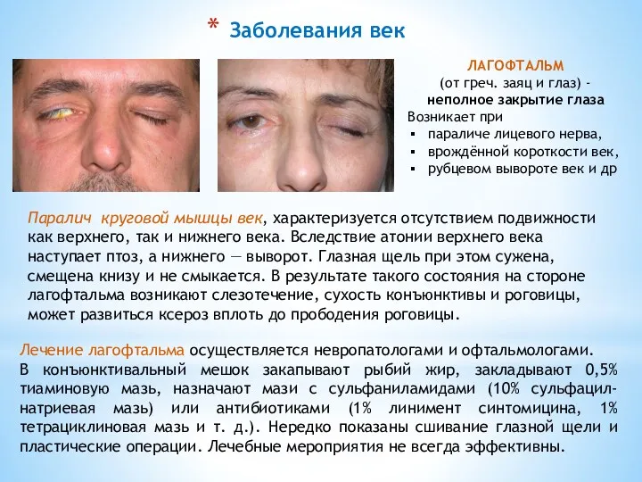 Заболевания век ЛАГОФТАЛЬМ (от греч. заяц и глаз) - неполное