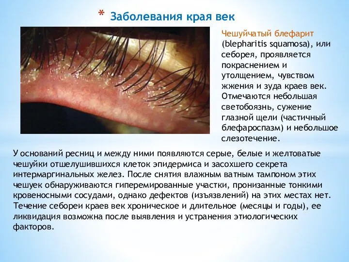 Заболевания края век Чешуйчатый блефарит (blepharitis squamosa), или себорея, проявляется