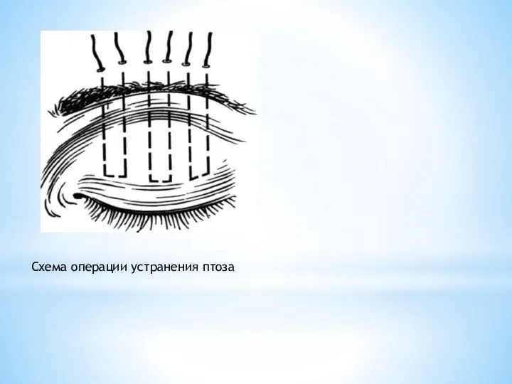Схема операции устранения птоза