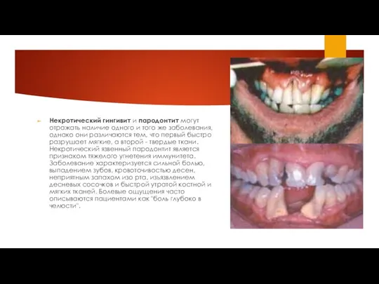 Некротический гингивит и пародонтит могут отражать наличие одного и того