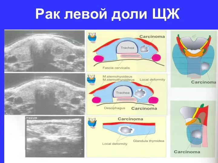 Рак левой доли ЩЖ