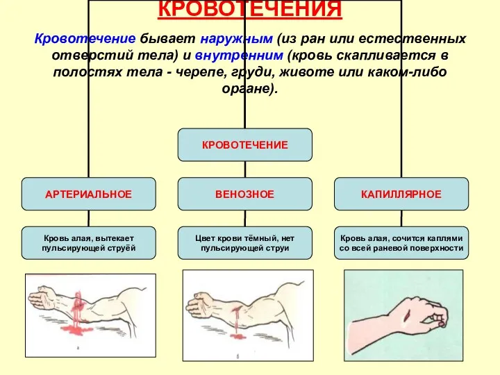 КРОВОТЕЧЕНИЯ Кровотечение бывает наружным (из ран или естественных отверстий тела)