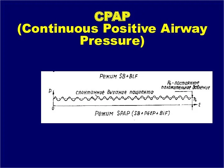 CPAP (Continuous Positive Airway Pressure)