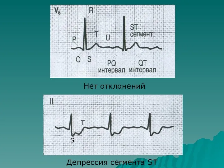 Нет отклонений Депрессия сегмента ST S T