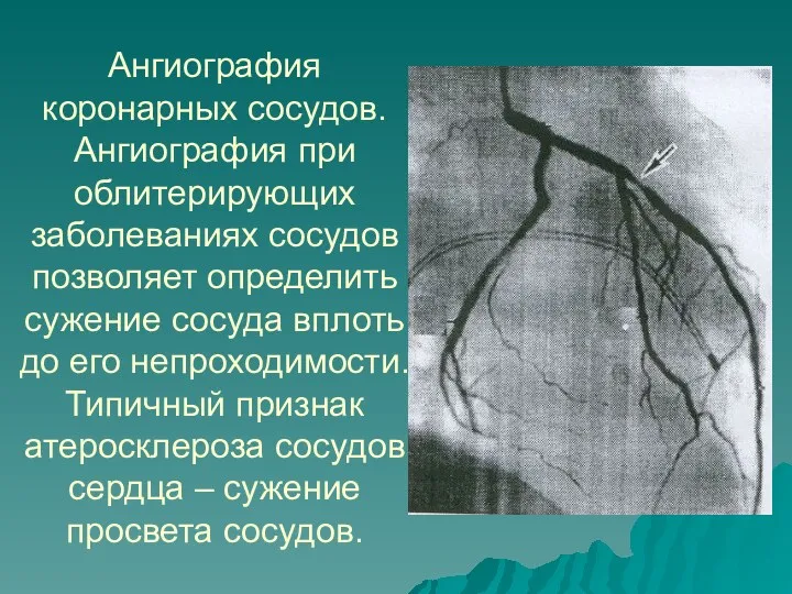 Ангиография коронарных сосудов. Ангиография при облитерирующих заболеваниях сосудов позволяет определить