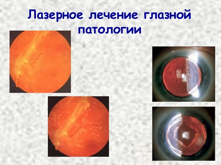 Лазерное лечение глазной патологии