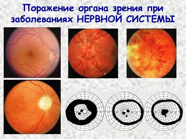 Поражение органа зрения при заболеваниях НЕРВНОЙ СИСТЕМЫ