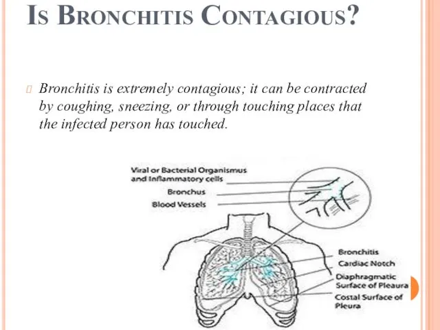 Is Bronchitis Contagious? Bronchitis is extremely contagious; it can be