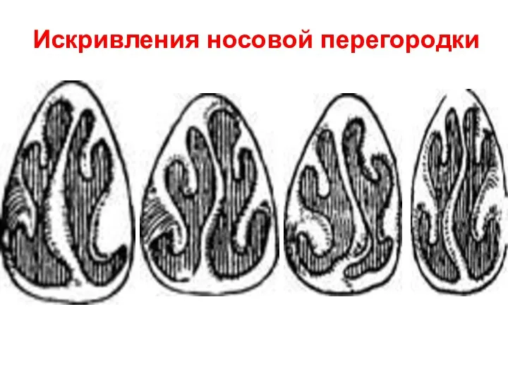 Искривления носовой перегородки