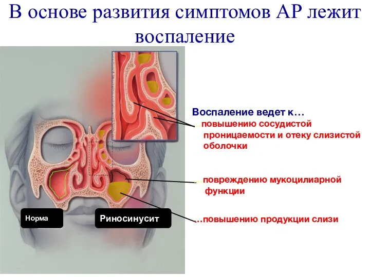 В основе развития симптомов АР лежит воспаление Воспаление ведет к…