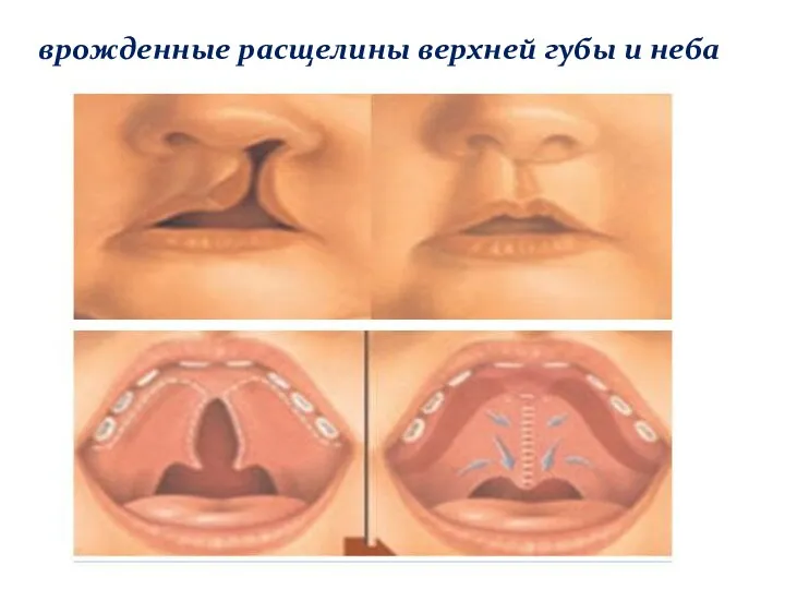 врожденные расщелины верхней губы и неба