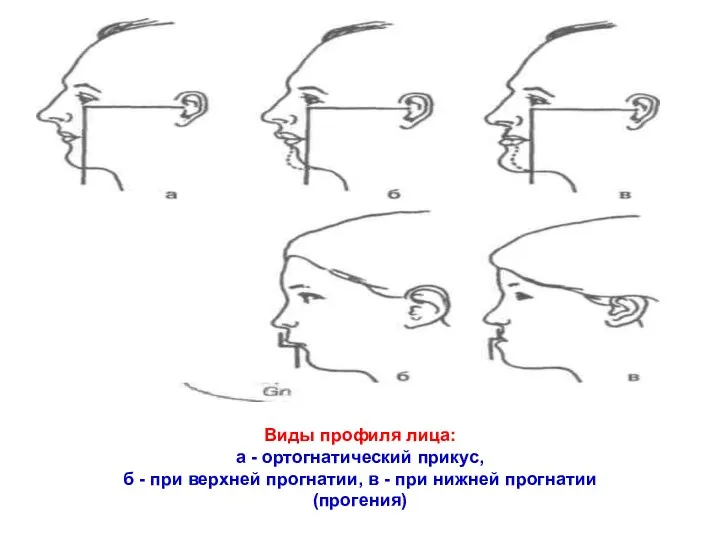 Виды профиля лица: а - ортогнатический прикус, б - при