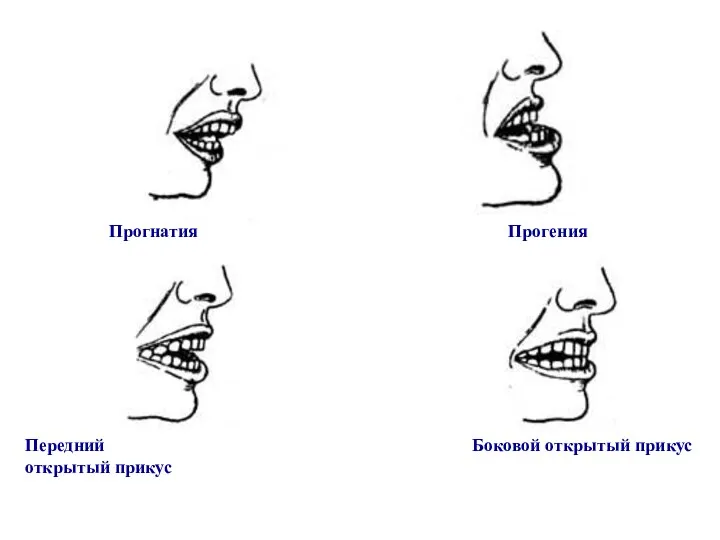 Прогнатия Прогения Передний Боковой открытый прикус открытый прикус