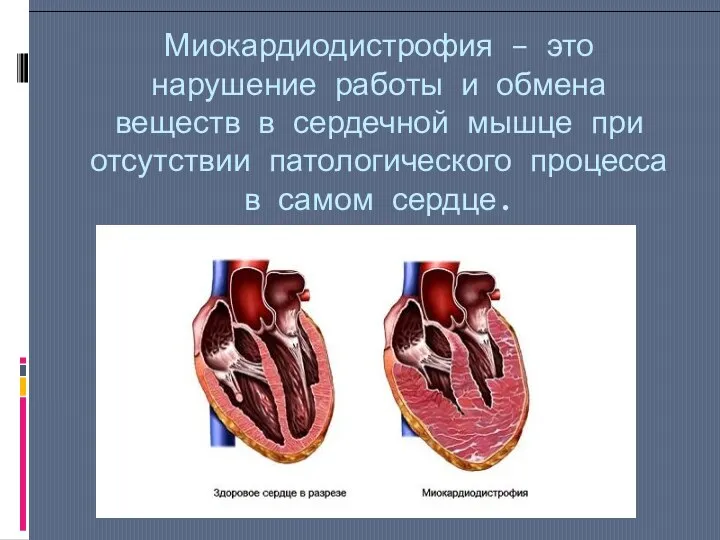 Миокардиодистрофия – это нарушение работы и обмена веществ в сердечной