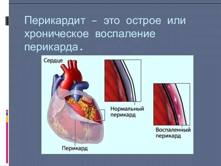 Перикардит – это острое или хроническое воспаление перикарда.