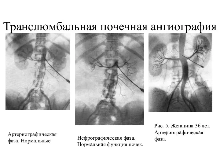 Транслюмбальная почечная ангиография Рис. 3.Мужчина 39 лет. Артериографическая фаза. Нормальные почечные артерии и