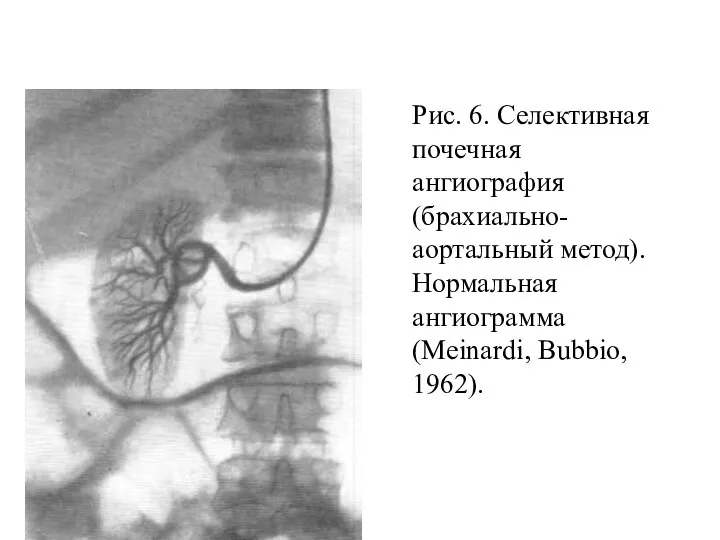 Селективная почечная ангиография Рис. 6. Селективная почечная ангиография (брахиально-аортальный метод). Нормальная ангиограмма (Meinardi, Bubbio, 1962).