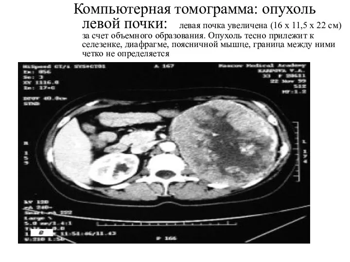 Компьютерная томограмма: опухоль левой почки: левая почка увеличена (16 х 11,5 х 22