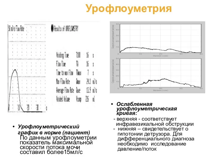 Урофлоуметрия Урофлоуметрический график в норме (пациент) По данным урофлоуметрии показатель максимальной скорости потока